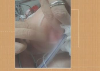 Paciente é encontrada com larvas na boca em hospital de Santa Maria: ‘Não acreditei’, diz irmã